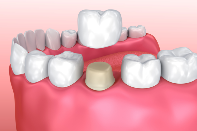 What Is A Dental Crown Glue?