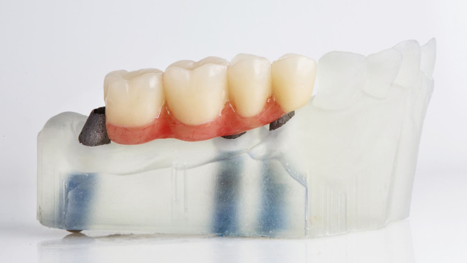 dental bridges coral gables