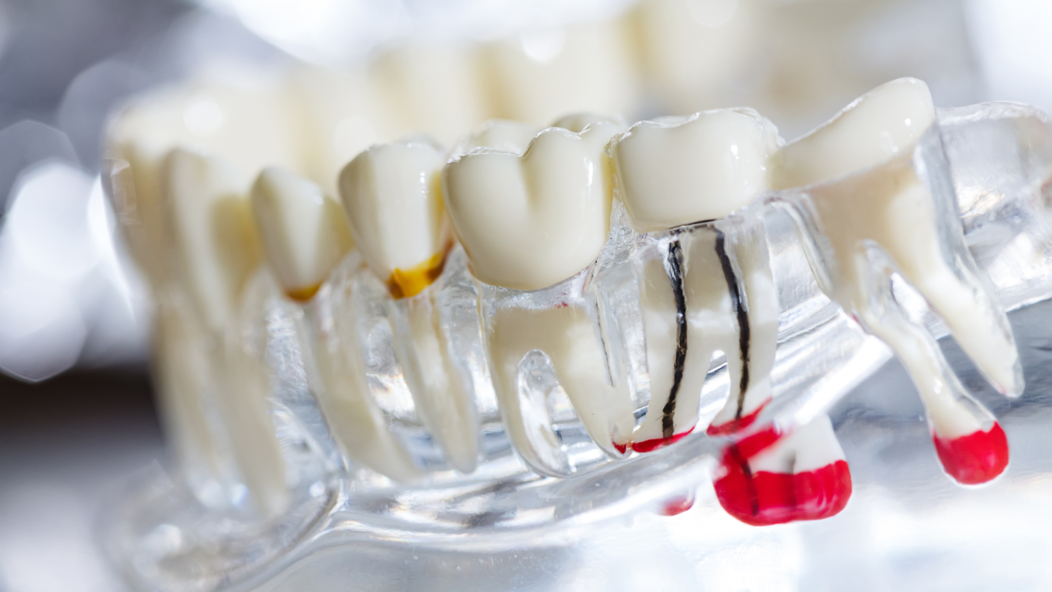 root canal therapy coral gables