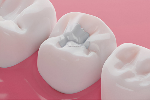 tooth colored fillings coral gables