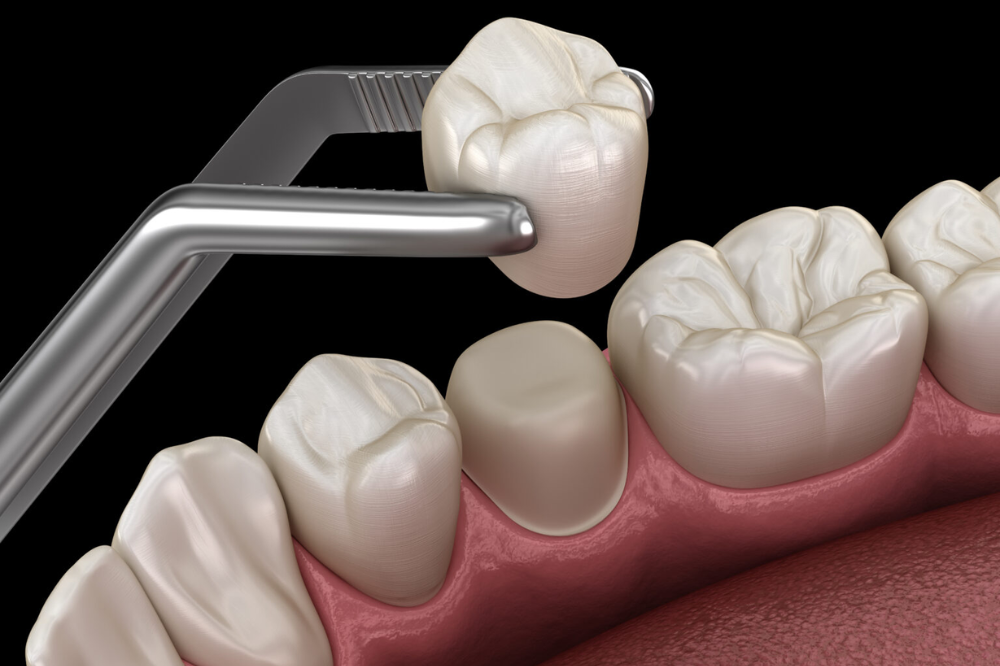 What Type of Dental Crown Should I Choose?