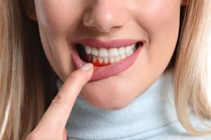Periodontal Treatment