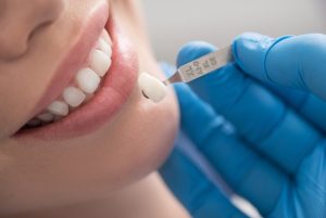 How to Prepare For A Dental Crown Treatment