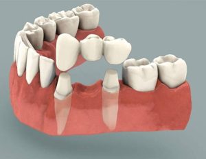 dental bridges