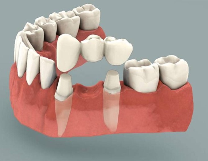 dental bridges