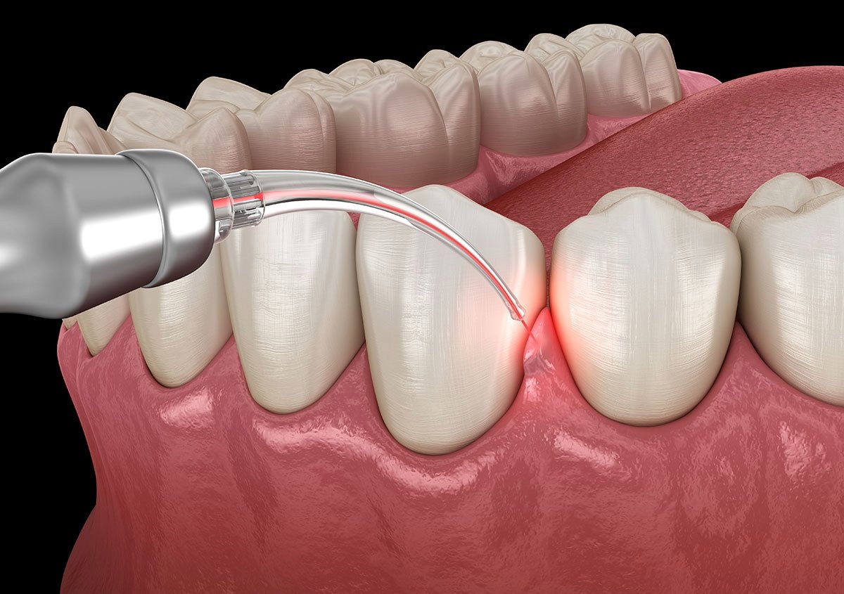 laser gum surgery benefits