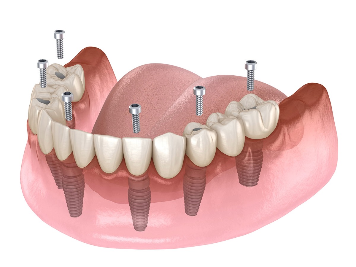 all on dental implants and how much do they cost