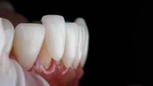 difference between veneers and crowns