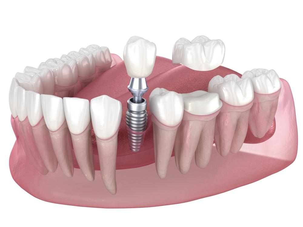 how dental implants work step-by-step explanation