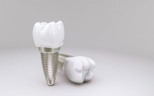 Dental implants: glued or screwed