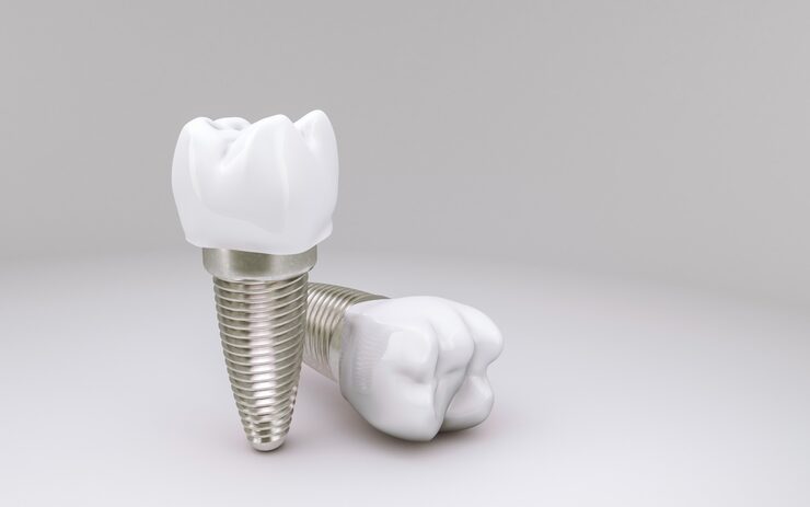 Dental implants: glued or screwed