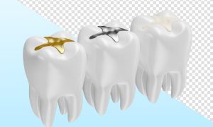Comparing dental fillings