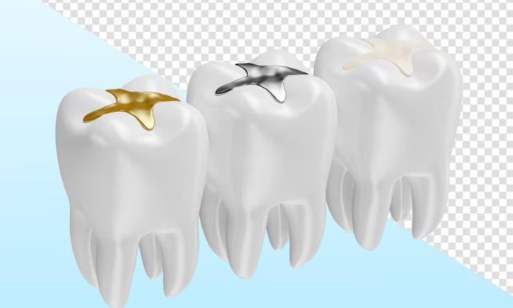 Comparing dental fillings